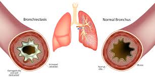 Image result for Inhalation Challenge Test
