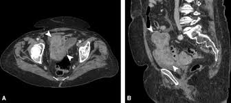Awareness of this may help both. Ct Imaging Of Peritoneal Carcinomatosis And Its Mimics Sciencedirect