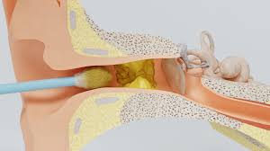 Parce que tes batailles n'en seront que plus épiques. Coton Tige Dangers Alternatives Comment Se Nettoyer Les Oreilles