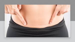 Controlled beams of laser are passed through the skin, and they render the chromophores ineffective in the hair follicles. Caesarean Section Scars And Laser Hair Removal Urbana