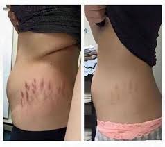Good Morning I Ve Got A Great Product For U To Try Have U Been Trying To Get Rid Of Those Stretch Stretch Mark Cream Stretch Marks Skin Tightening Cream