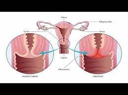 Pin On Vulvar Itching