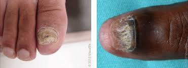 Image result for Pitting nails feet