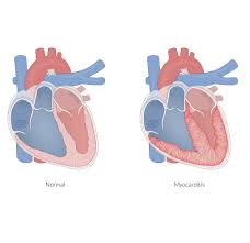 Image result for Myocarditis