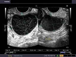 If your healthcare provider finds an unexpected cyst or enlarged ovary during a pelvic exam, you should have a vaginal ultrasound to assess for cancer. A Gallery Of High Resolution Ultrasound Color Doppler 3d Images Ovaries Ovarian Cyst Ultrasound Ovaries