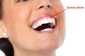 Check spelling or type a new query. Gummy Smile An Esthetic Problem Or Something More Murphy Orthodintics