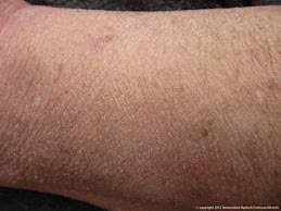 Kulit tangan kering merupakan gangguan kulit yang sering kali terjadi kepada semua orang. Cara Mengatasi Kulit Kering Dan Bersisik Obat Alami Kulit Obat Untuk Keputihan Herbal