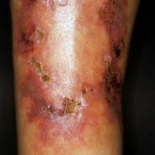 Tuberculosis (tb) is caused by bacteria (mycobacterium tuberculosis) that most often affect the lungs. Nodular Vasculitis Altmeyers Encyclopedia Department Dermatology
