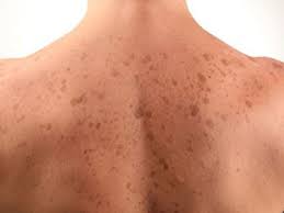 Orange brown spots on hands. Brown Spots Treatment At Mayoral Dermatology A Cosmetic Dermatolgoist