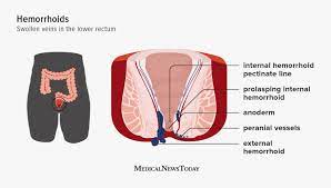 Hemorrhoids: Causes, Treatments, And Prevention
