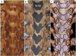 We did not find results for: Anatomical Analysis Of The Human Ligamentum Flavum In The Thoracic Spine Clinical Implications For Posterior Thoracic Spinal Surgery Journal Of Orthopaedic Science