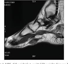 When it's overly stretched, you can get tiny tears in its surface. Figure 3 From Ledderhose Disease Clinical Radiological Ultrasound And Mri And Anatomopathological Findings Semantic Scholar