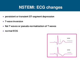 After further testing, if a blockage is found, your medical team will decide. Ecg Interpretation Nstemi