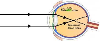 Penderitanya tidak bisa membedakan garis tegak maupun mendatar dan dibantu oleh kacamata berlensa silinder. Alat Optik Biology Quizizz