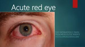 Image result for Acute Red Eye