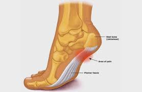 Image result for Calcaneal Apophysitis