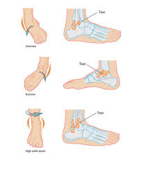 Ankle Sprains