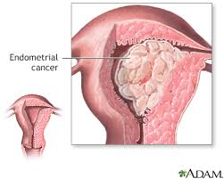 If it is cancer, then you will probably have caught it early. Endometrial Cancer Information Mount Sinai New York