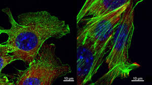 Noninvasive or in situ cancer has not spread outside its original location. Regulatory Rnas Promote Breast Cancer Metastasis Eurekalert Science News