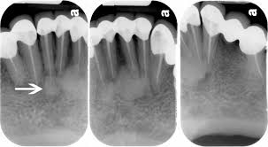 The lesion occurs in and near the periodontal ligament around the apex of a tooth, usually a mandibular incisior. Dr Shawneen Gonzalez En Twitter Radiographoftheday Periapical Cemento Osseous Dysplasia Stage 3 Radiopaque Stage Http T Co Nivbrg0ezr