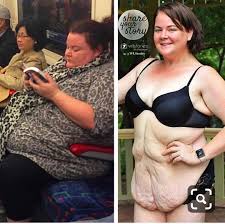 Props To This Woman For Showing Us What The Effects Of Massive Weight Loss Looks Like Instagramreality