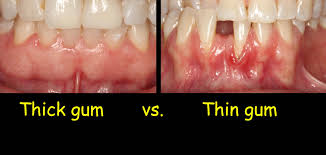 How to treat gum recession? Thick Vs Thin Gum Capitol Hill Dentistry