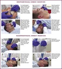 Rubbing against your nostrils probably indicates that the oxygen nose piece is too large, while pinching indicates that it is the wrong size for your nose shape. Basic Airway Management And Decision Making Veterian Key