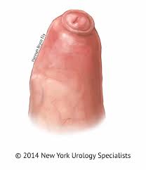 Trattamento della Fimosi: Specialisti della Circoncisione a New York -  Adult Circumcision in NYC