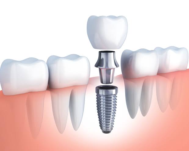 Dental Implants in San Marcos | Types of Dental Implants | Dr. Robert  Donnelly