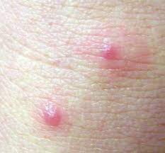 How Do You Treat Turkey Mite Bites