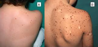 Image result for Spitz Nevus
