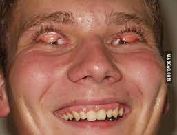 Eyelid flip / c bao co eyelid flip. One Of My Biggest Fears In The Childhood Flipped Eyelids 9gag