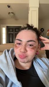 Kaci Jay Vitiligo Painting