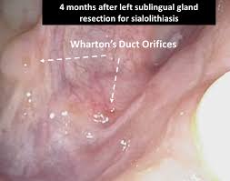 Image result for Sialolithiasis