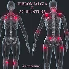 A dor da fibromialgia e fadiga crônica by basitpindi on march 2, 2020march 2, 2020 in fibromialgia portugese leave a comment facebook tweet google+ a fala a ponta dos dedos batendo na mesa. Acupuntura E Fibromialgia Estudando Mtc
