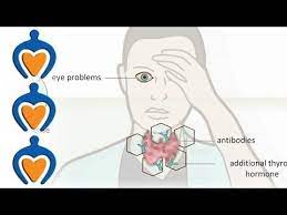 Aortic valve disease is a condition in which the valve between the main pumping chamber of your heart (left ventricle) and the main artery to your body (aorta) doesn't work properly. Thyroid Problems Most Common Thyroid Problems Symptoms And Treatment Youtube