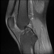 Bucket Handle Tear Of The Medial Meniscus Radiology Case Radiopaedia Org