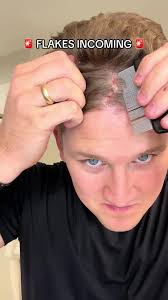 Huge Dandruff Removal Flakes Mrs Amanda