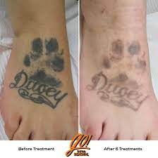 Going through laser tattoo removal? Facebook