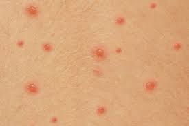 Before 1995, chicken pox parties were popular. Chickenpox Nhs