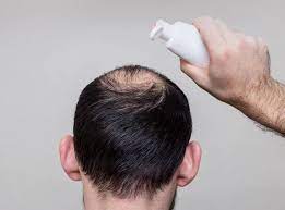 It prevents further hair loss and is clinically women's rogaine is clinically proven to regrow hair in 80 percent of women who apply it once each day. Does Rogaine Expire Everything To Know