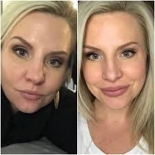 Quit drinking like a week ago. Skin Progress After 3 Months Sobriety Stopdrinking