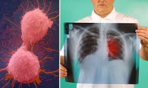 Still, if you have any of these problems, it's important to see your doctor right away so the cause can be found and treated, if needed. Gps Diagnosis Of Lung Cancer Questioned After Third Die Within 90 Days Express Co Uk