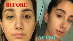 makeup after rhinoplasty saubhaya