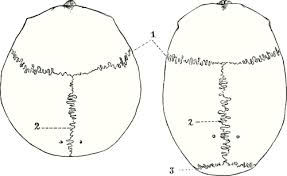 The lambda is the midline bony landmark where the lambdoid sutures and sagittal suture meet, between the occipital and two parietal bones. Bregma Wikiwand