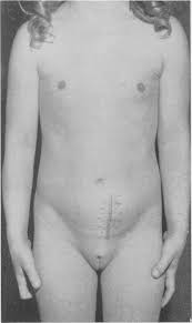 Pseudoprecocious Puberty in Girls as a Result of Estrogen Ingestion | New  England Journal of Medicine