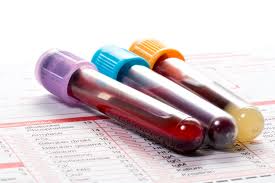 Share on pinterest a new blood test could revolutionize. Universal Cancer Blood Test Detects And Locates 50 Types Of Tumors