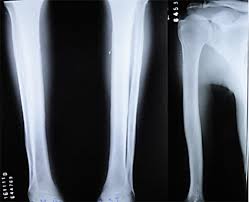 Image result for periostitis