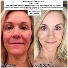 Look at This transformation…Thanks for sharing Kimberly Majestic Stoker 🌸  “My skin still isn't perfect, but with years of consistency and what I like  to call big girl skincare my skin is