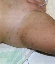 Meningitis Kinder